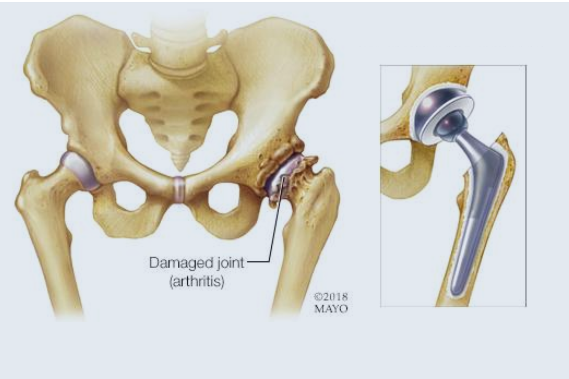 Total Hip Replacement