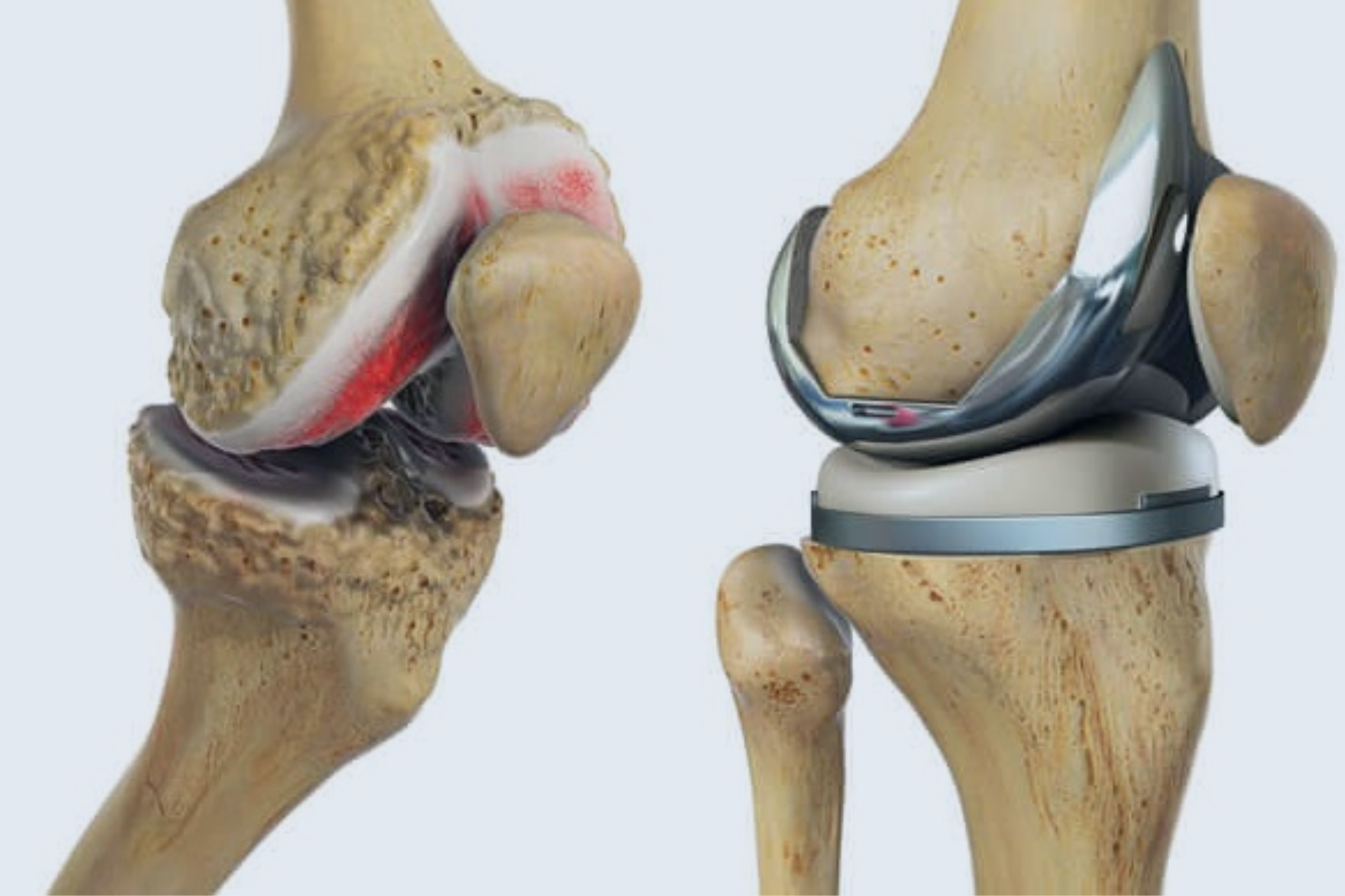 Total Knee Replacement